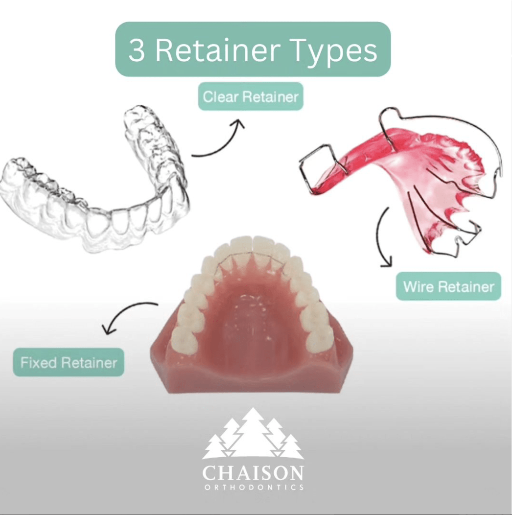 3 Retainer Types Chaison Orthodontics